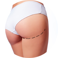 micorlipofilling-roma-glutei